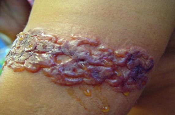 Ernstige reactie op henna tatoeage met blaarvorming