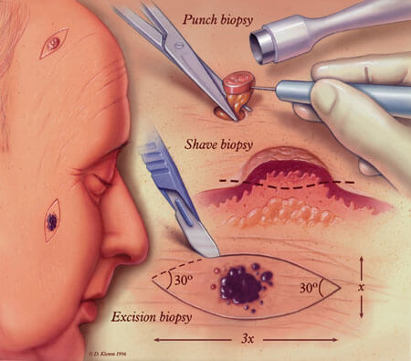 De verschillende vormen van huidbiopsie