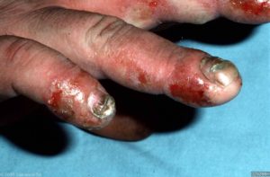 Acute pijnlijke blaasjeseczeem aan de vingertoppen