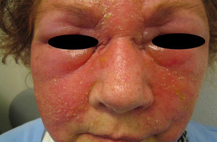 Erysipelas aan beide gezichtshelften met ernstige zwelling van de oogleden
