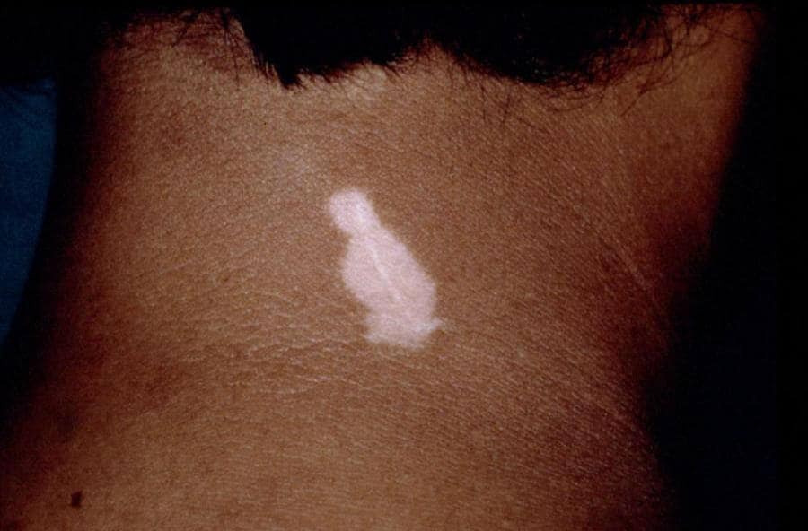 Koebner fenomeen; vitiligo ontstaan in een litteken