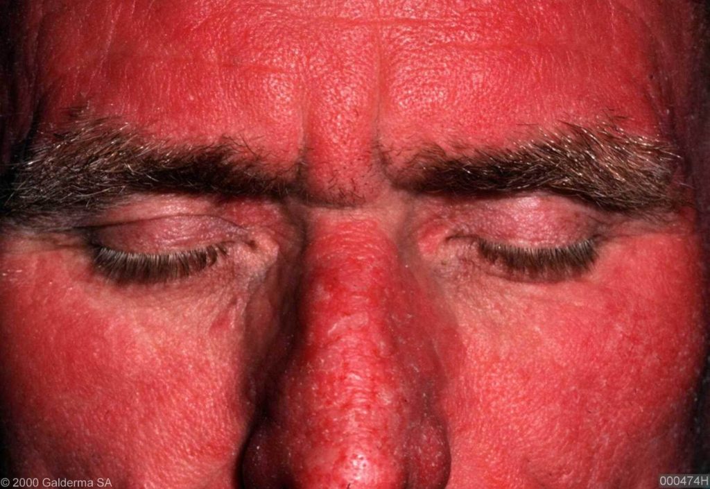 Het gezicht kan geheel rood zijn bij een zonneallergie