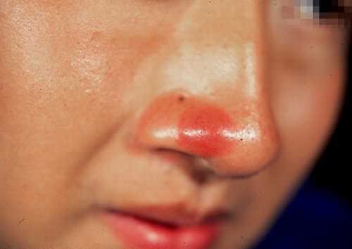 Pseudolymfoom op de neus