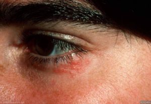 Dermatitis periocularis, plekken zitten vooral rondom de ogen
