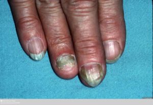 Schimmelinfectie van de vingernagels