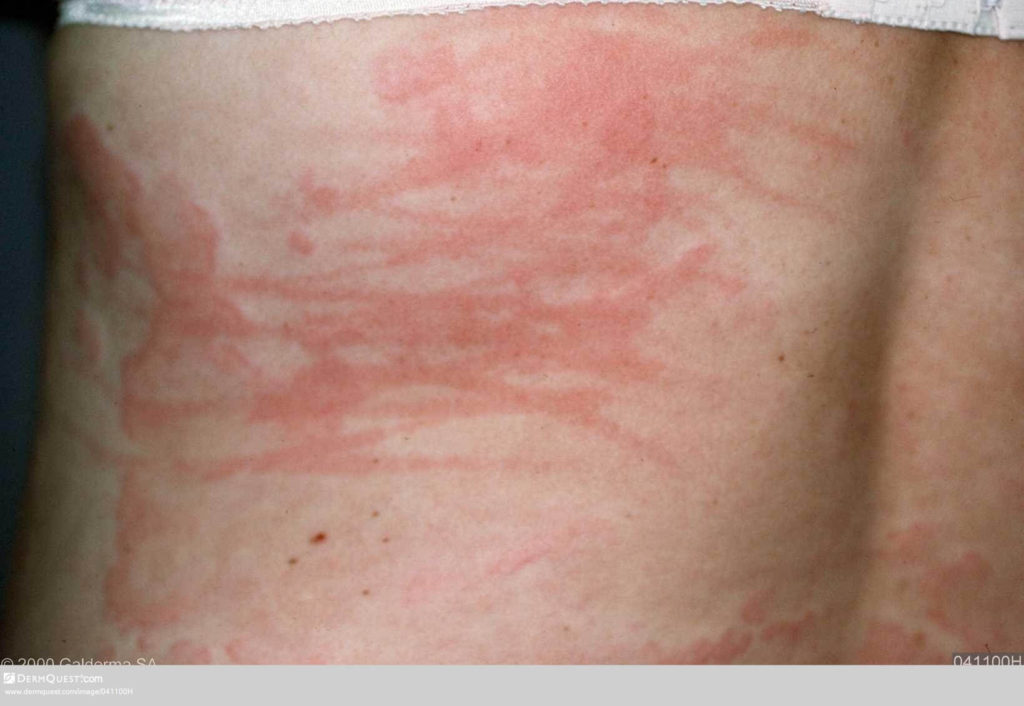 Positieve dermografisme: krabeffecten op de rug worden ook rood en gezwollen