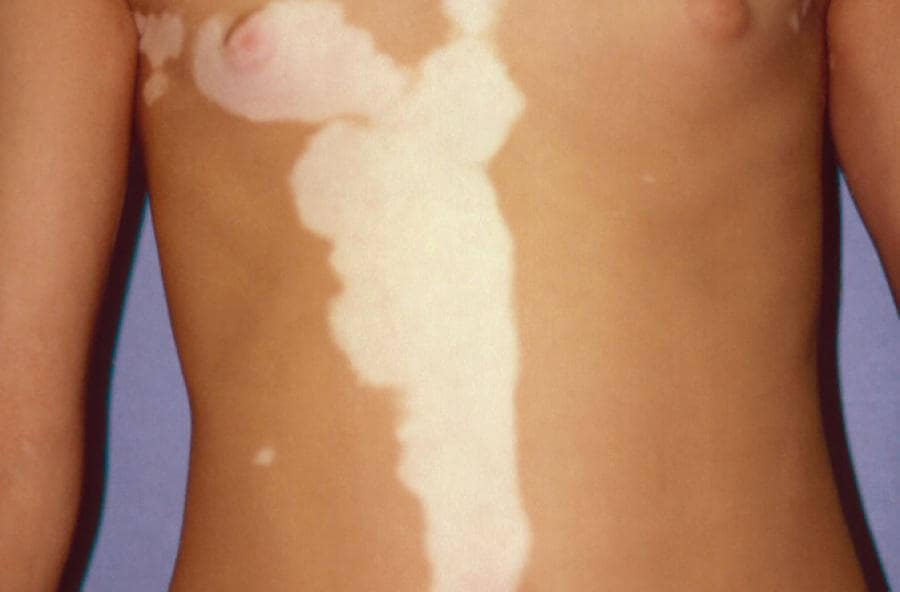 Eenzijdige vorm van vitiligo