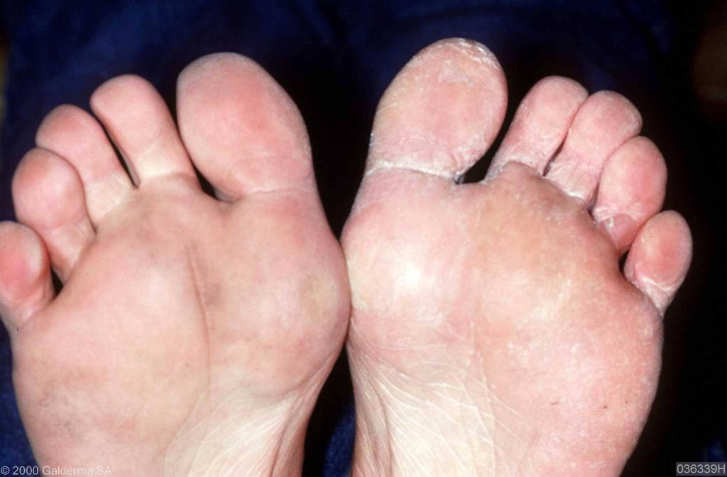 Schimmelinfectie van de tenen van de linker voet