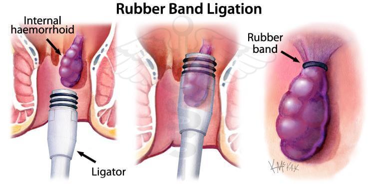 Rubberband ligatie: Met een kijkbuisje wordt de aambei opgezogen waarna aan de basis ervan een elastiekje wordt gelegd. Het aambei sterft daarna af.
