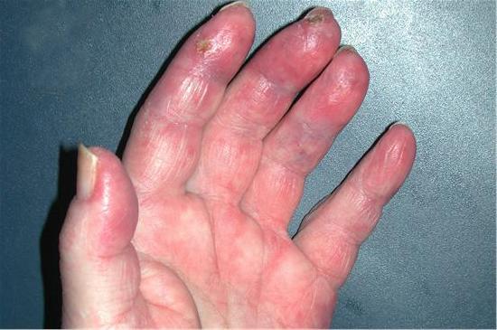 Winterhanden; paarsblauwe verkleuring aan de vingers, let op het ontstane zweertje aan de wijsvinger