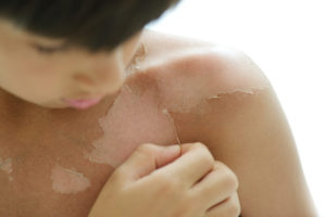 Zonverbranding tijdens kinderjaren kan later bijdragen tot vorming van huidkanker 