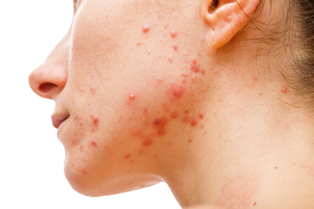 Onderkaak-acne komt minder voor bij volwassen vrouwen dan eerder werd gedacht 