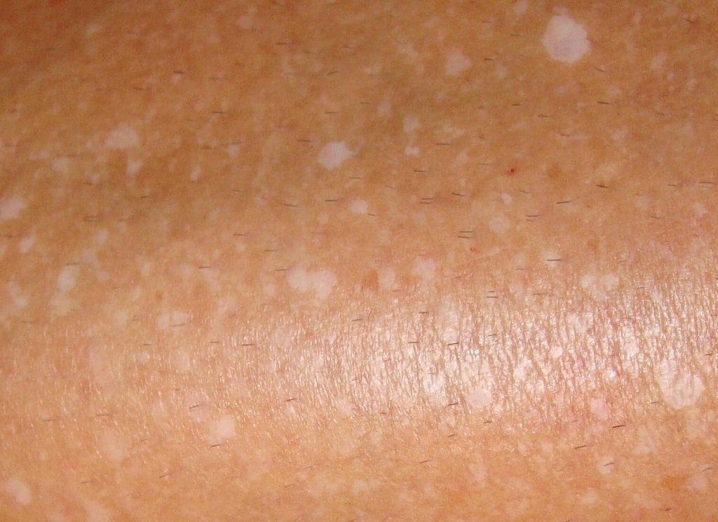 Detailfoto van IGH in de blanke huid