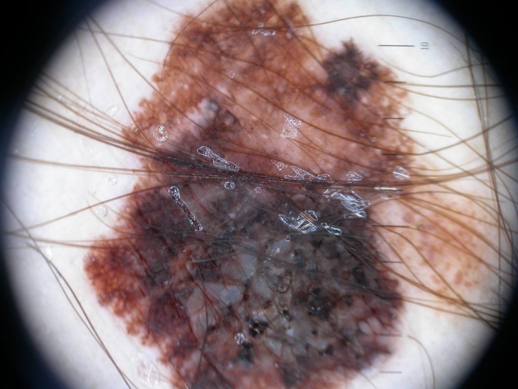 Een voorbeeld van een dikkere melanoom onder de scoop