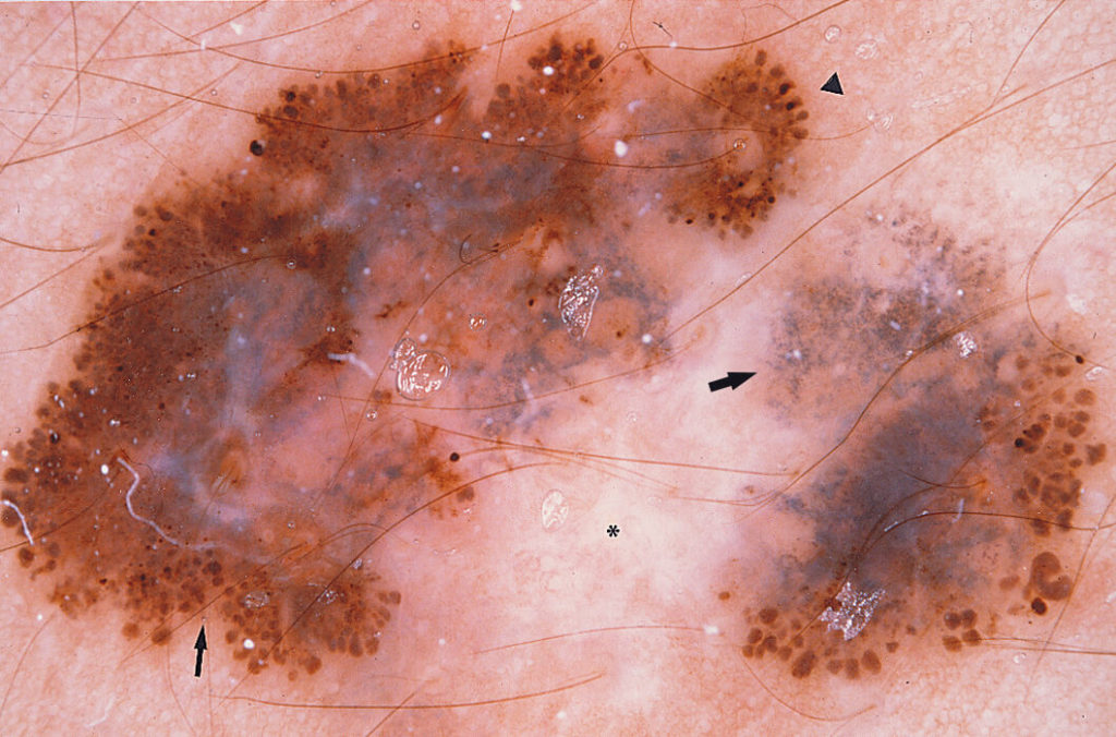 Voorbeeld van een melanoom onder de scoop