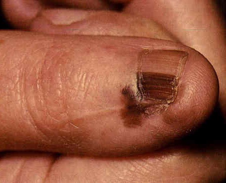Bruine verkleuring van de duimnagel met uitloop naar de huid van de nagelbasis