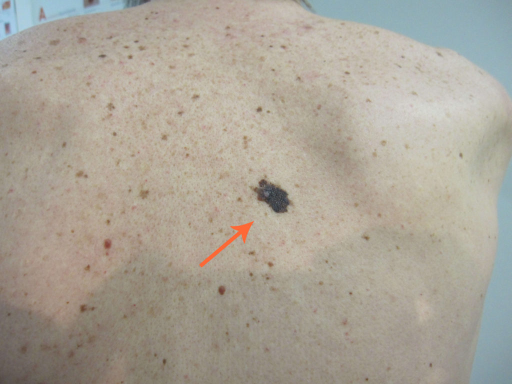 Lokatie van een primair melanoom op de rug, in dit geval niet te missen