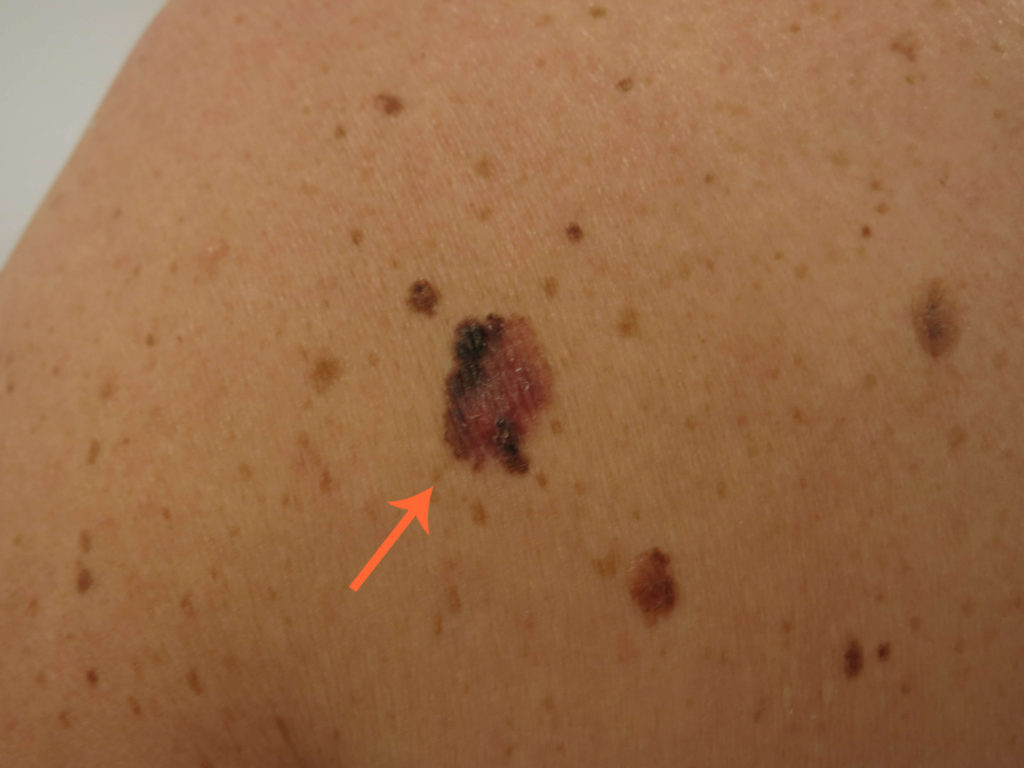 Dit melanoom is waarschijnlijk ontstaan uit een bestaande moedervlek, gezien het groot aantal andere moedervlekken op de rug....