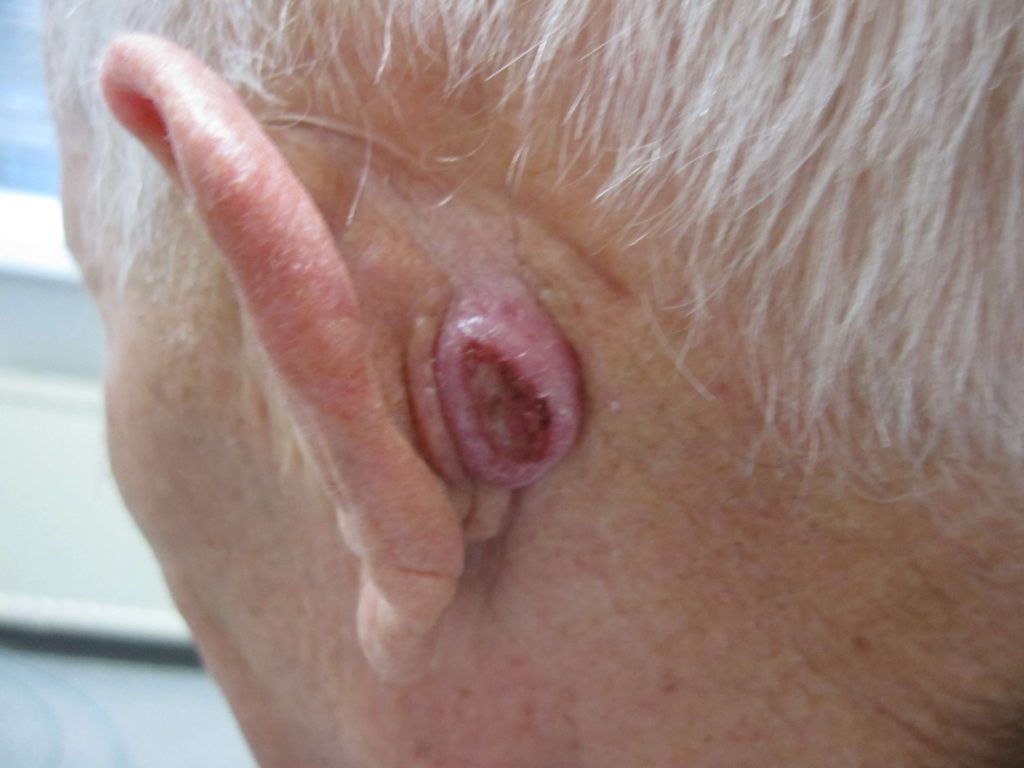 Plaveiselcelcarcinoom "verstopt" achter het oor...