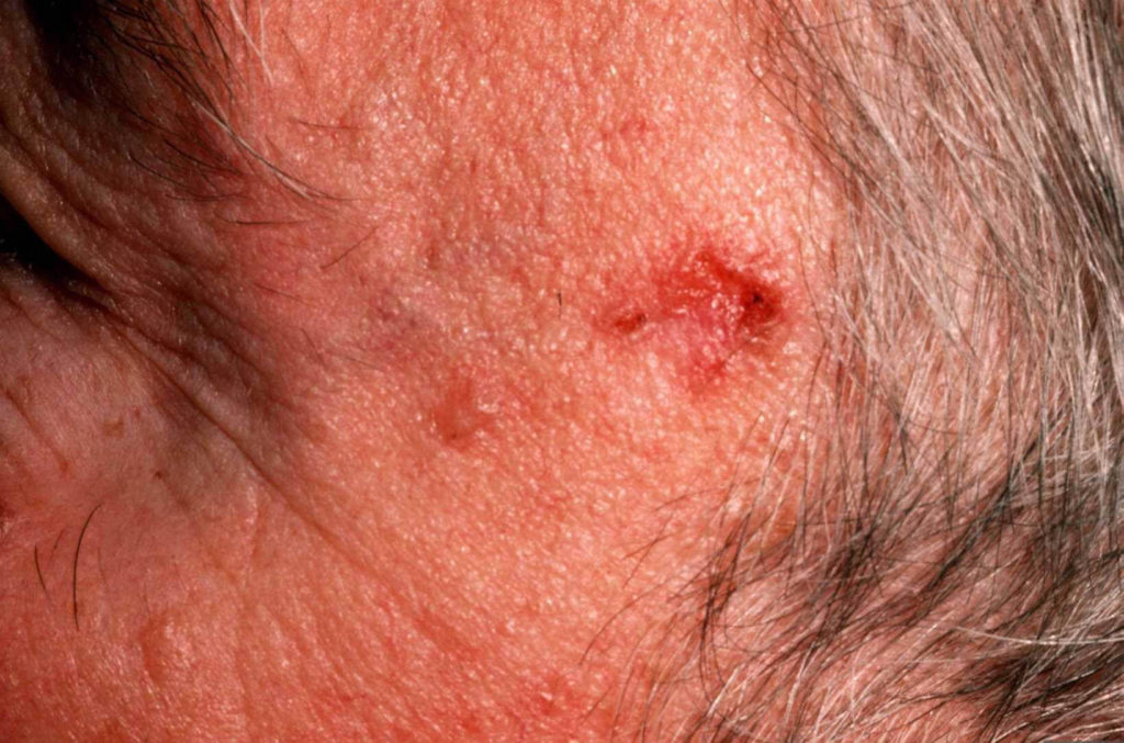 Basaalcelcarcinoom: Een enkele rode plek op de linker slaap die gemakkelijk zweert en bloedt