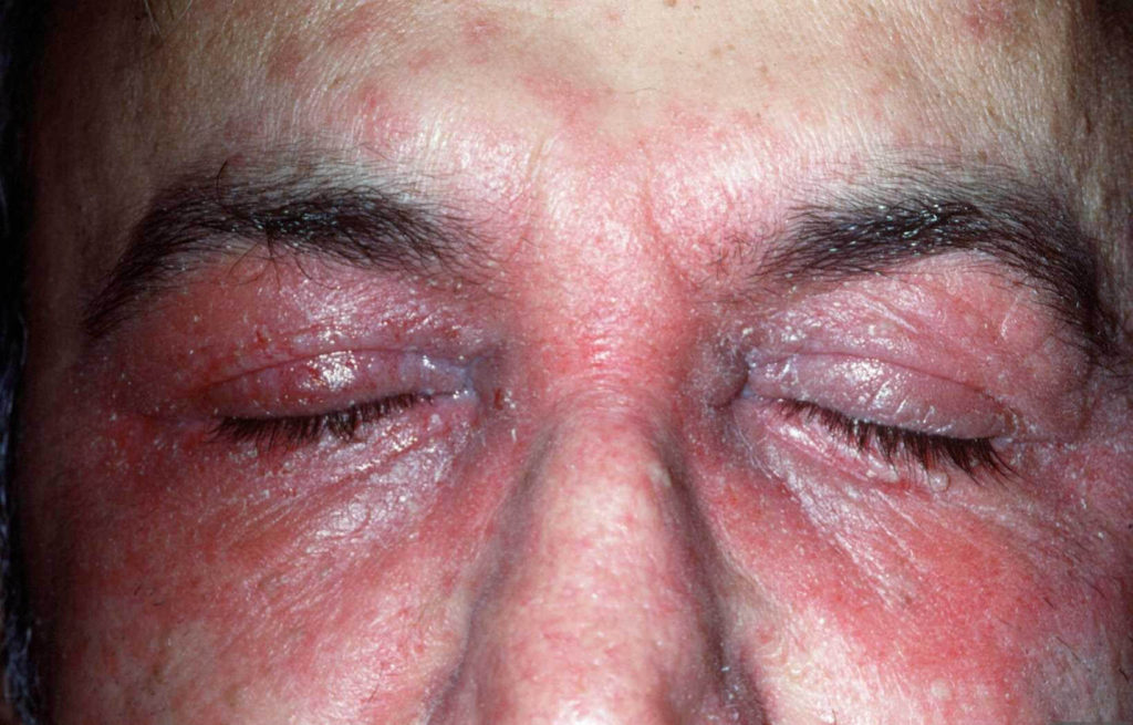Roodschilferende rode plekken rondom de ogen door een allergie op een conserveermiddel in een dagcrème