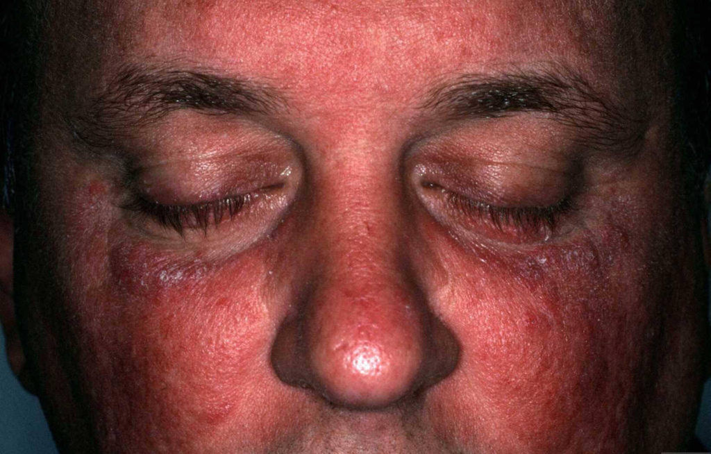Rood schilferende plakkaten onder de ogen bij psoriasis