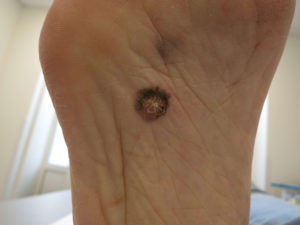 Het acraal melanoom zit vaak "verstopt" onder de voet
