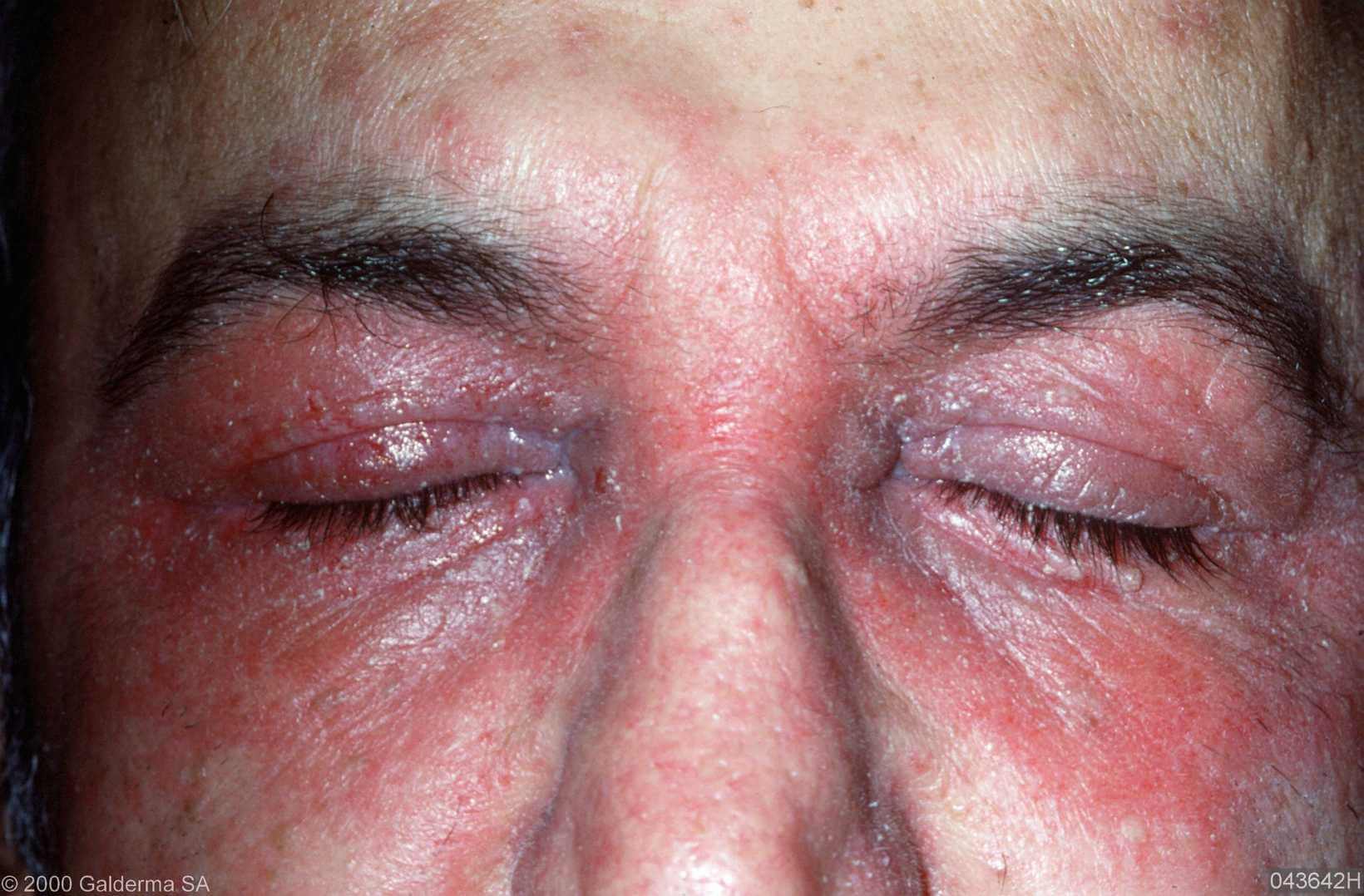 Allergie voor cosmetica Huidarts.com