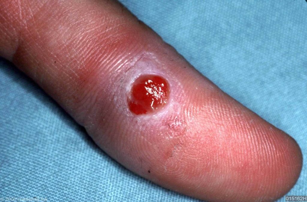 Bloedend tumortje op de vinger