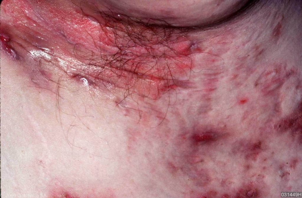 Acne inversa onder de oksel met littekens