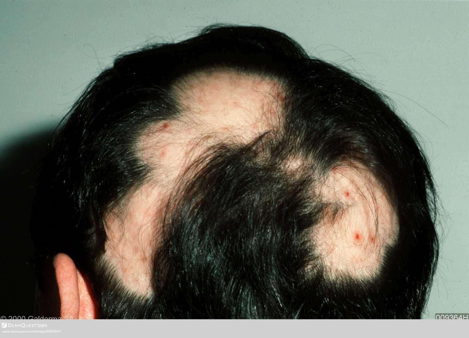 Alopecia Baldness (Alopecia)
