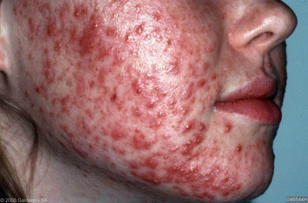 Ernstige acne vulgaris