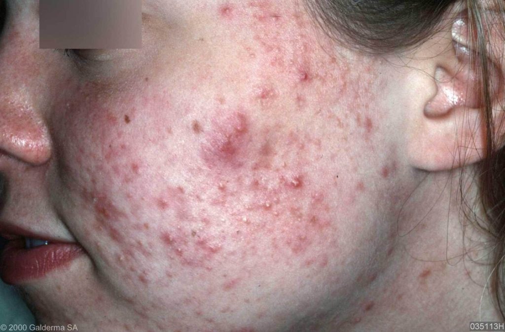 Matig ernstige acne vulgaris