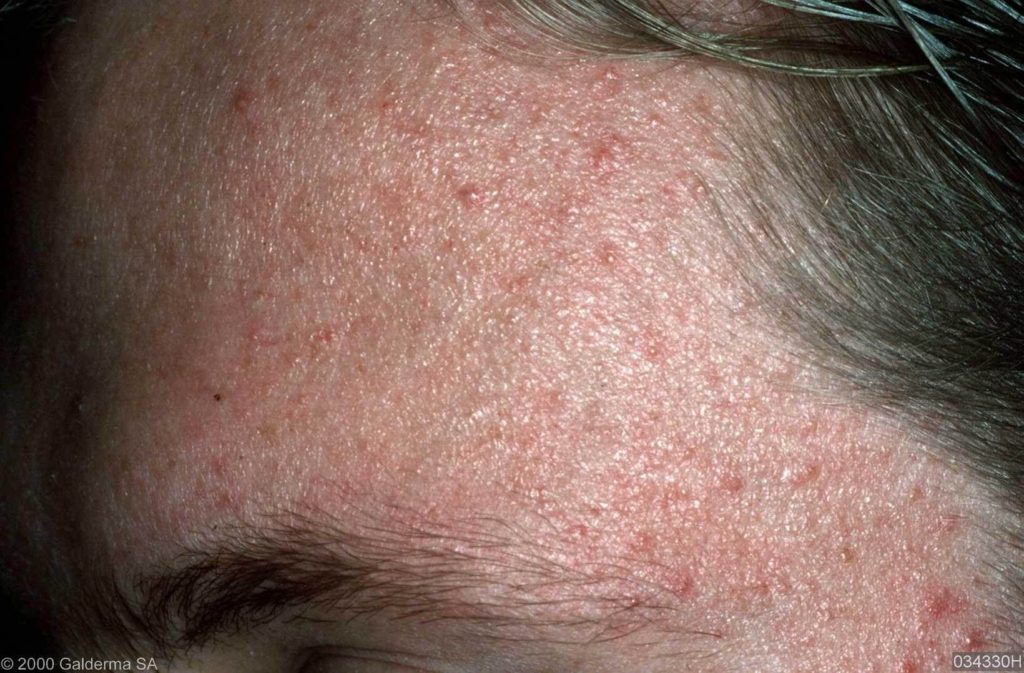 Milde acne vulgaris