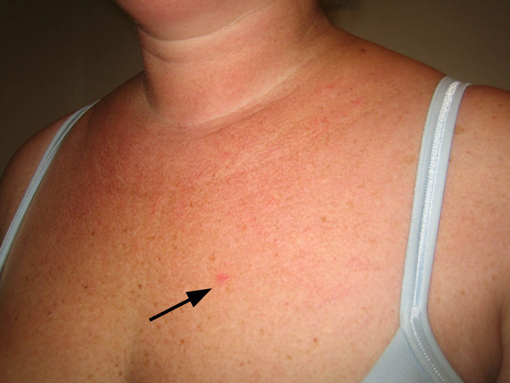 Civatte hals en zonneschade van het decoletté. Patiënte blijkt daarnaast ook een basaalcelcarcinoom (huidkanker) te hebben ontwikkeld aan de linkerzijde (zie pijl)