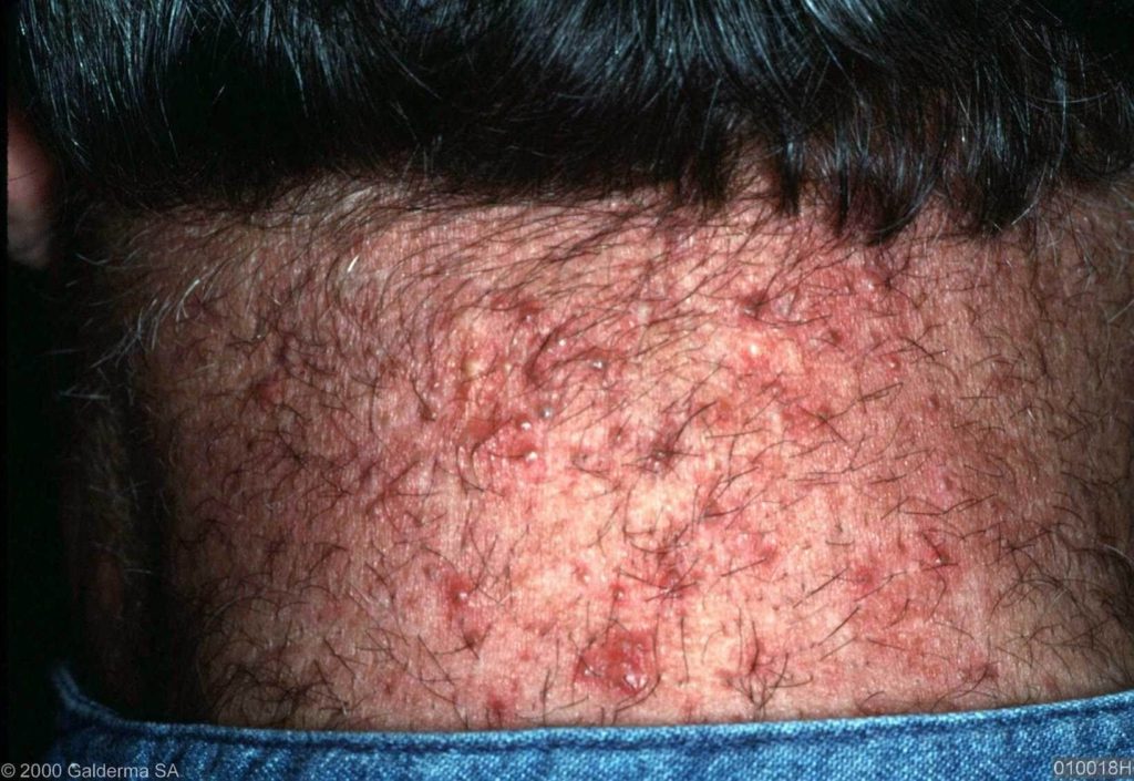 Uitgebreide folliculitis op de nek, niet zelden verward met acne