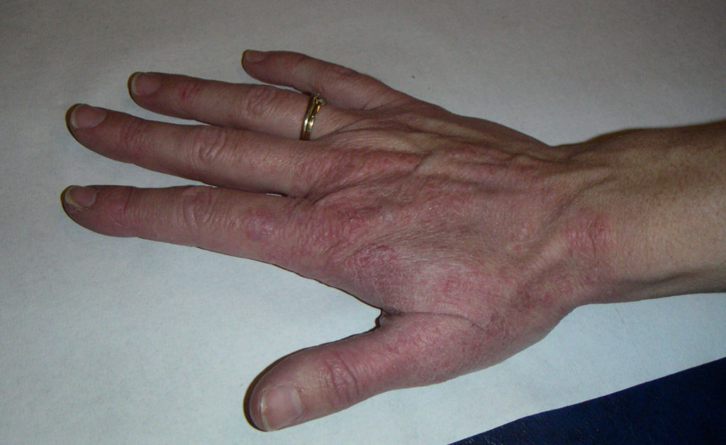 Schimmelinfectie van de rechter handrug