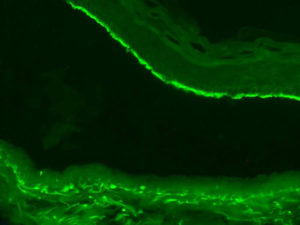 Onder de microscoop: Lineaire afzettingen van IgA antistoffen in de opperhuid