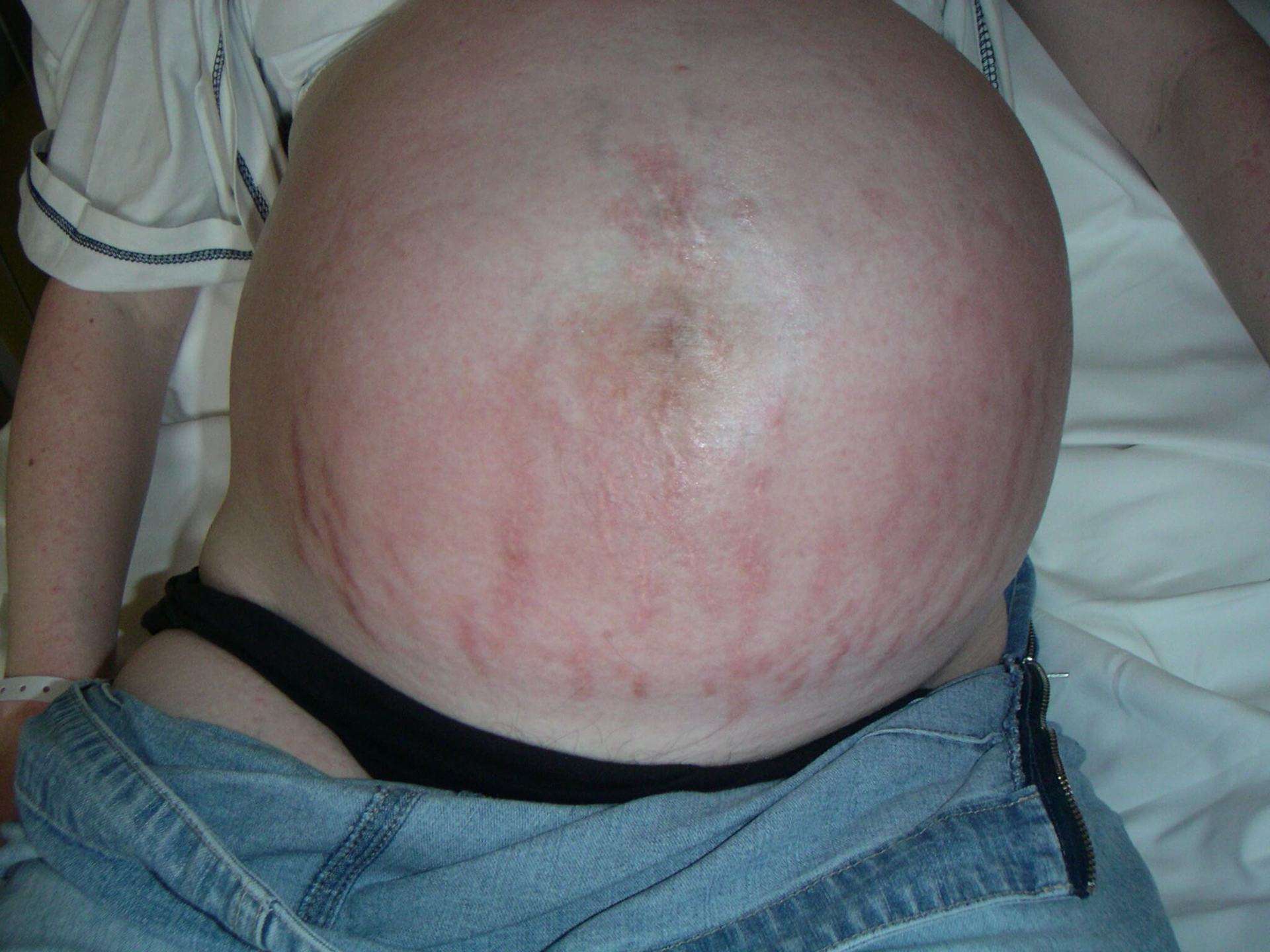 Pruritic urticarial papules and of pregnancy (PUPPP) - Huidarts.com