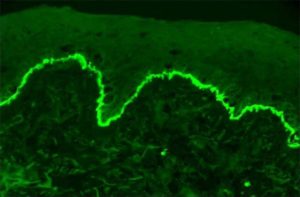 Microscopsich beeld: IgG antistoffen langs het onderste deel van de opperhuid