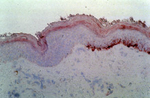 Microscopiche beeld van een speciale pigmentkleuring ; aan de linker zijde is de kleuring negatief, hier zit de vitiligo vlek