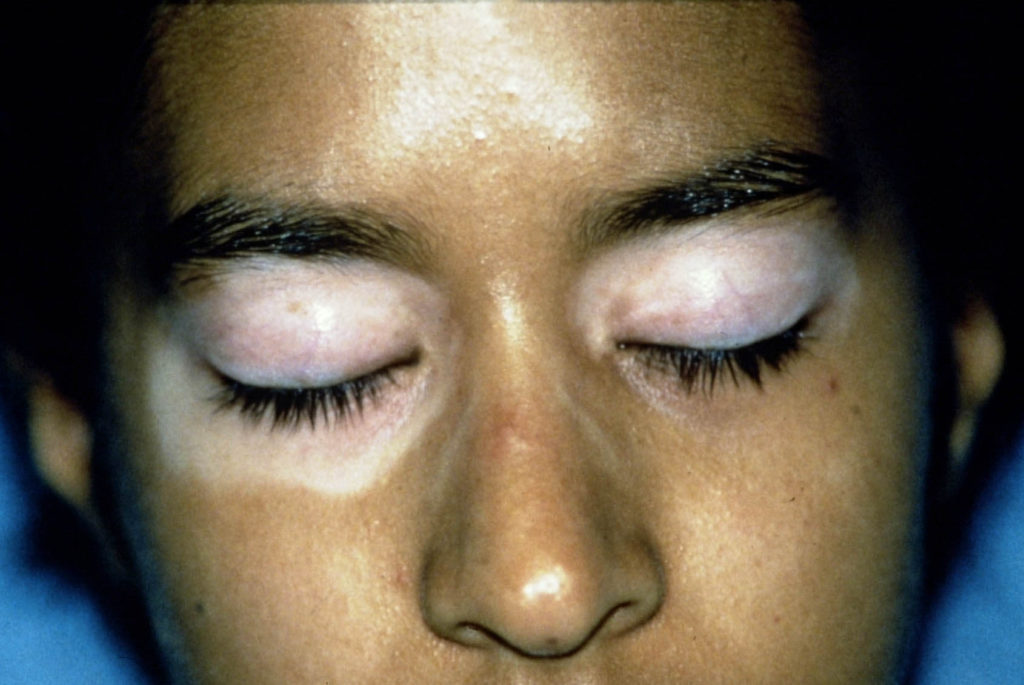 Vitiligo rondom de ogen vóór UVB therapie