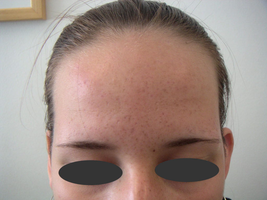 Donkere littekens na het doormaken van acne