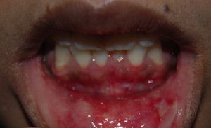 Pijnlijke wondjes en zweertjes op het tandvlees en mondslijmvlies                      