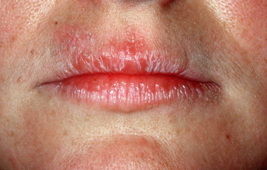 Schilferende rode opgezette lippen door contactallergie voor lanoline in lippenzalf (uierzalf)