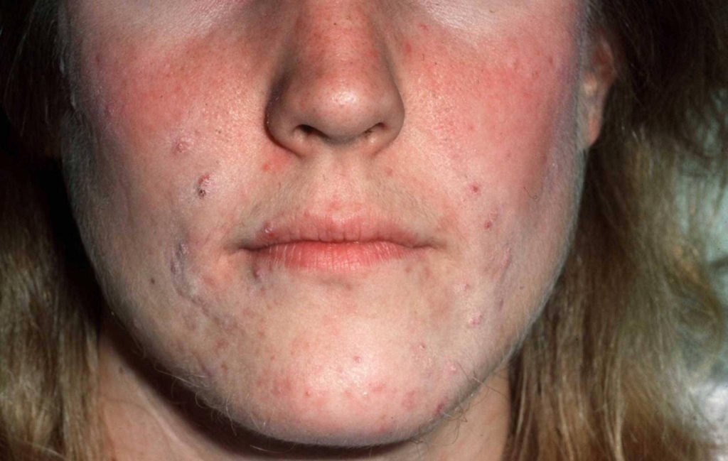 Hirsutisme en acne. Deze 28 jarige vrouw bleek later cysten in haar eierstokken te hebben.