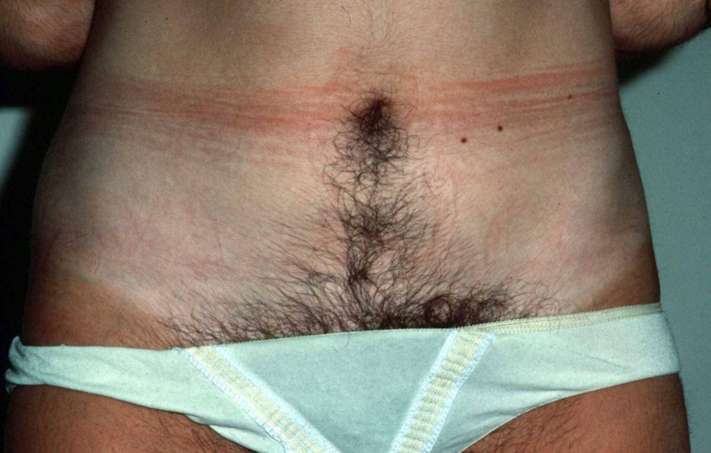 Hirsutisme bij een 32 jarige vrouw. De schaamharen reiken tot aan haar navel.