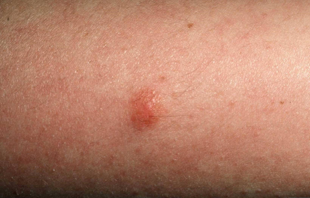 Bijna onopvallend oranje kleurig bultje op het bovenbeen van een 42 jarige man. Na excisie werd de diagnose amelanotisch melanoom gesteld.