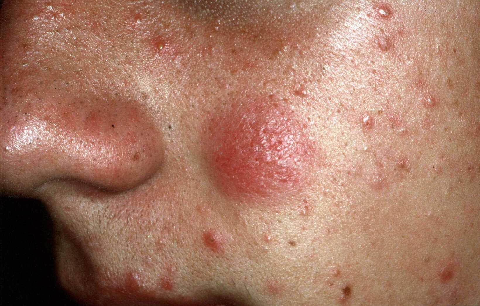 Mucormycose Gezicht ROSACEA DEMODEX MIJT Dermaesthetics