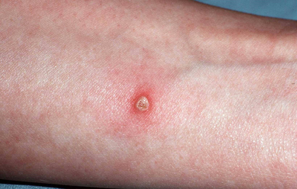 Pyoderma gangrenosum begint vaak met een kleine pustel 